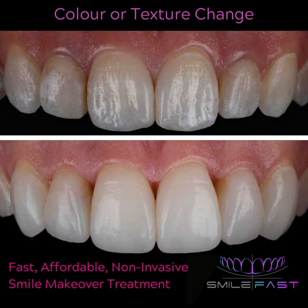 Composite Veneers - 740 Dental Smilefast Affordable Veneers
