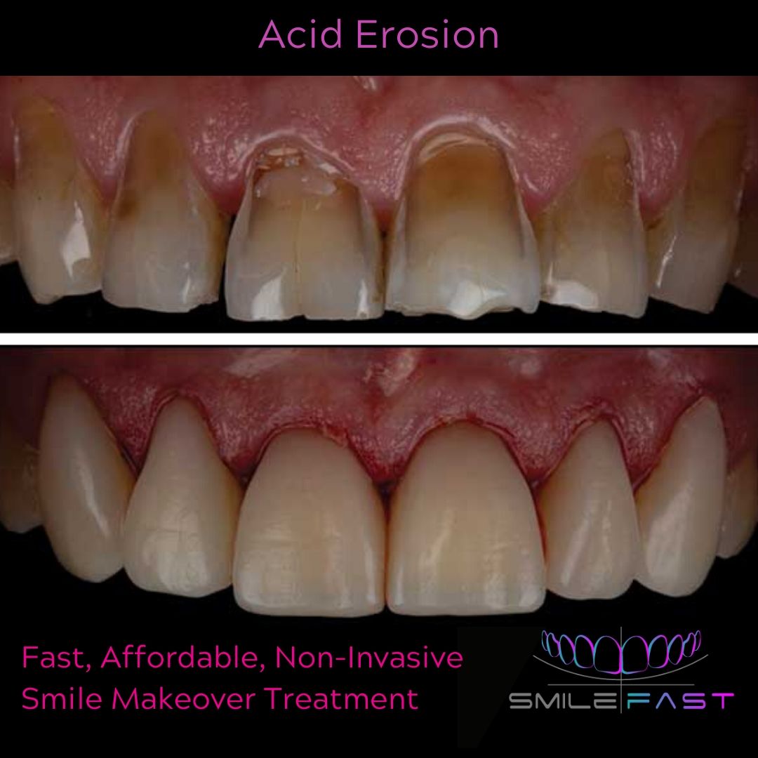 Composite Veneers - 740 Dental Smilefast Affordable Veneers