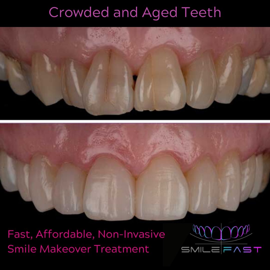 Composite Veneers - 740 Dental Smilefast Affordable Veneers