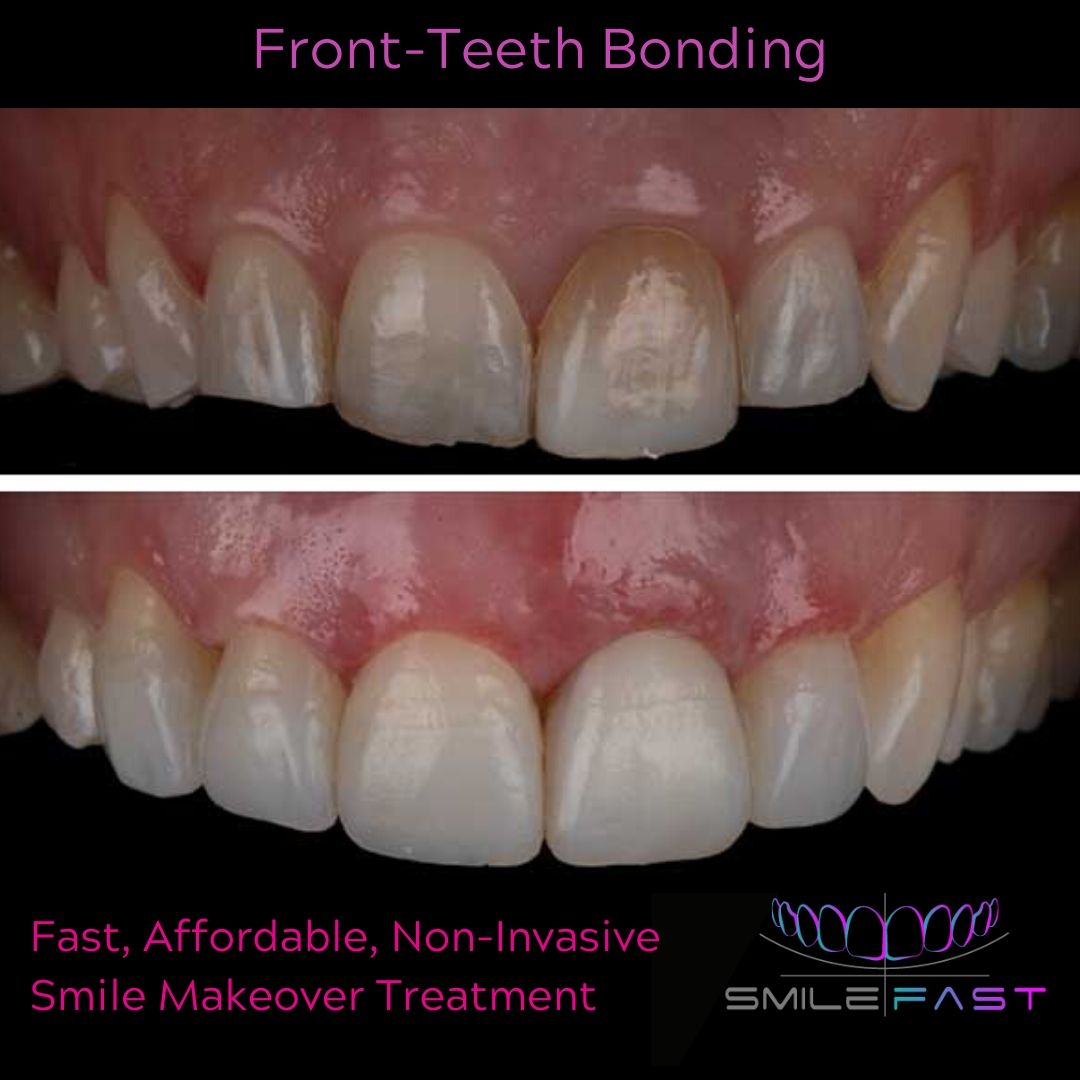 Composite Veneers - 740 Dental Smilefast Affordable Veneers