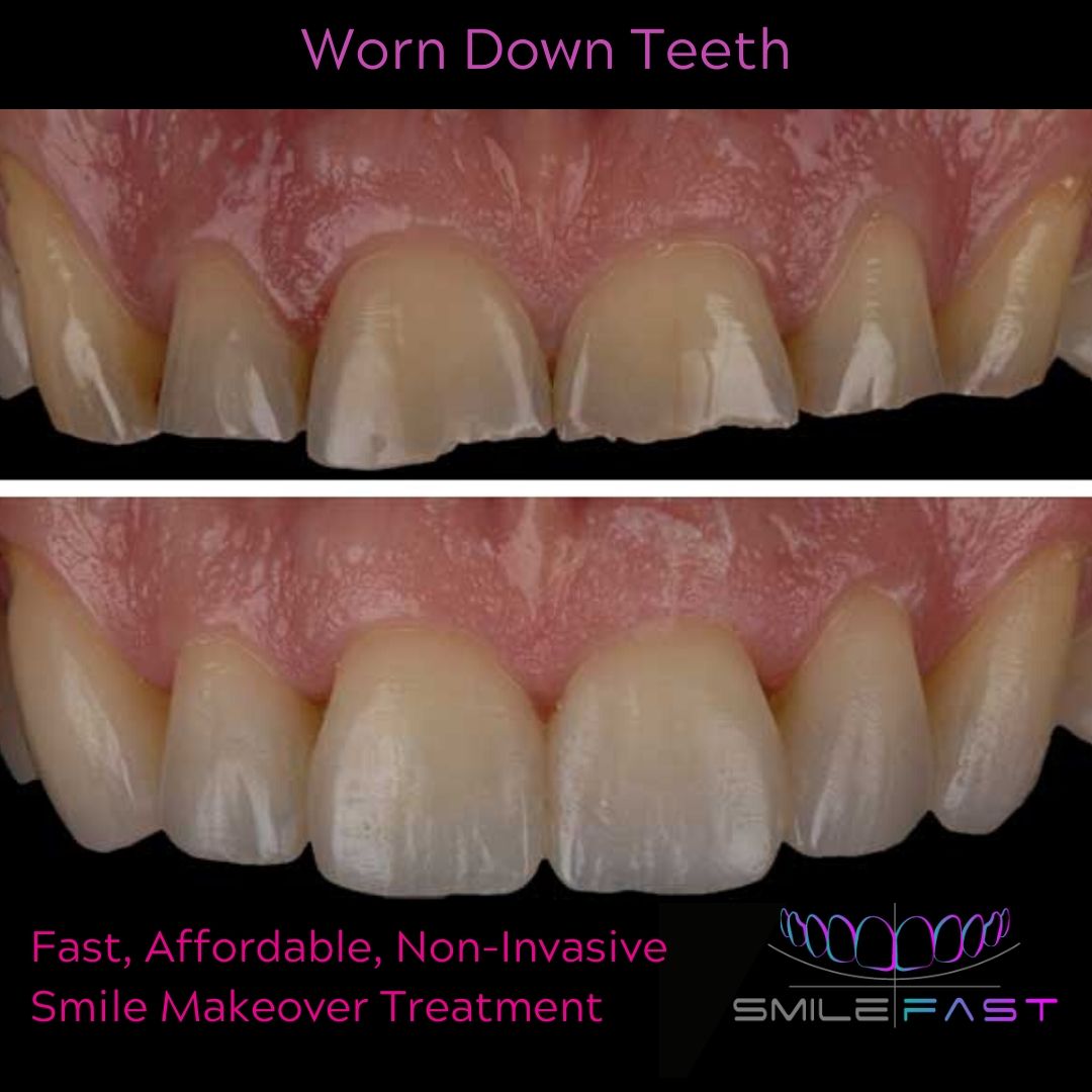 Composite Veneers - 740 Dental Smilefast Affordable Veneers