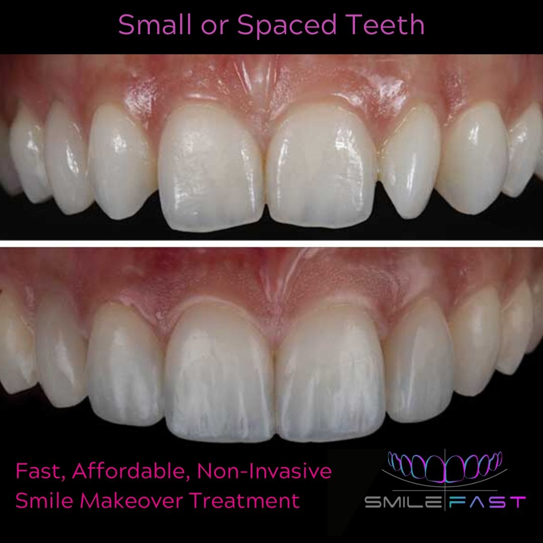 Composite Veneers - 740 Dental Smilefast Affordable Veneers