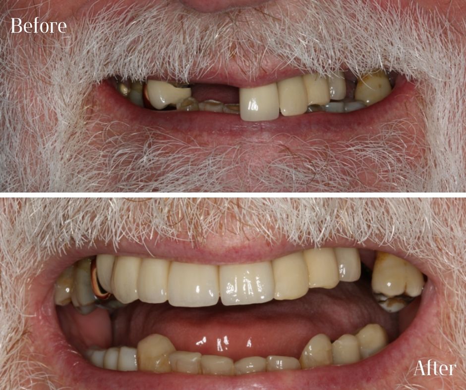Dental Implants - 740 Dental Dental Implants treatment photos