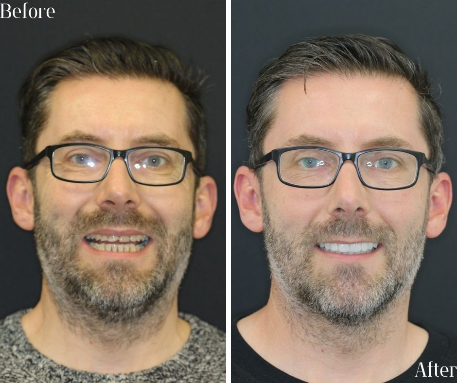 Composite Veneers - 740 Dental Smile Makeover Before and after