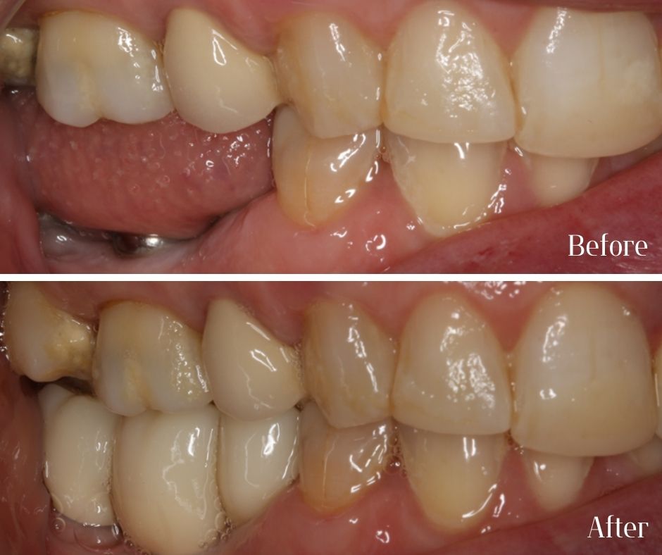 Dental Implants - 740 Dental Dental Implants treatment photos