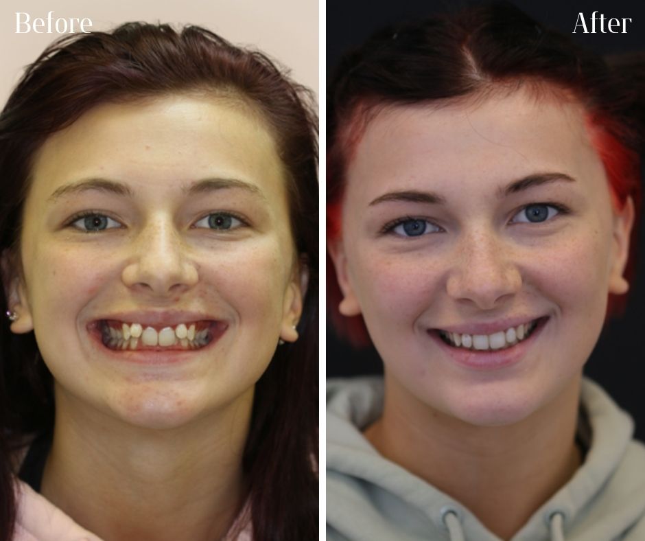 Straight Teeth Braces - 740 Dental Invisalign and braces treatment photos
