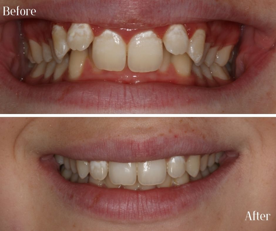 Straight Teeth Braces - 740 Dental Straight Teeth Braces - 740 Dental