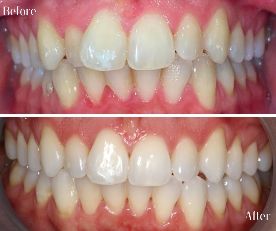Composite Veneers - 740 Dental Composite Veneers - 740 Dental