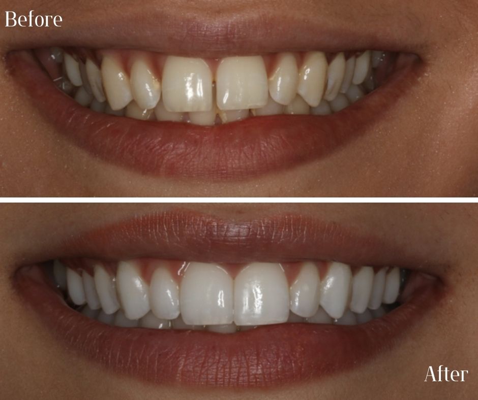 Straight Teeth Braces - 740 Dental Straight Teeth Braces - 740 Dental