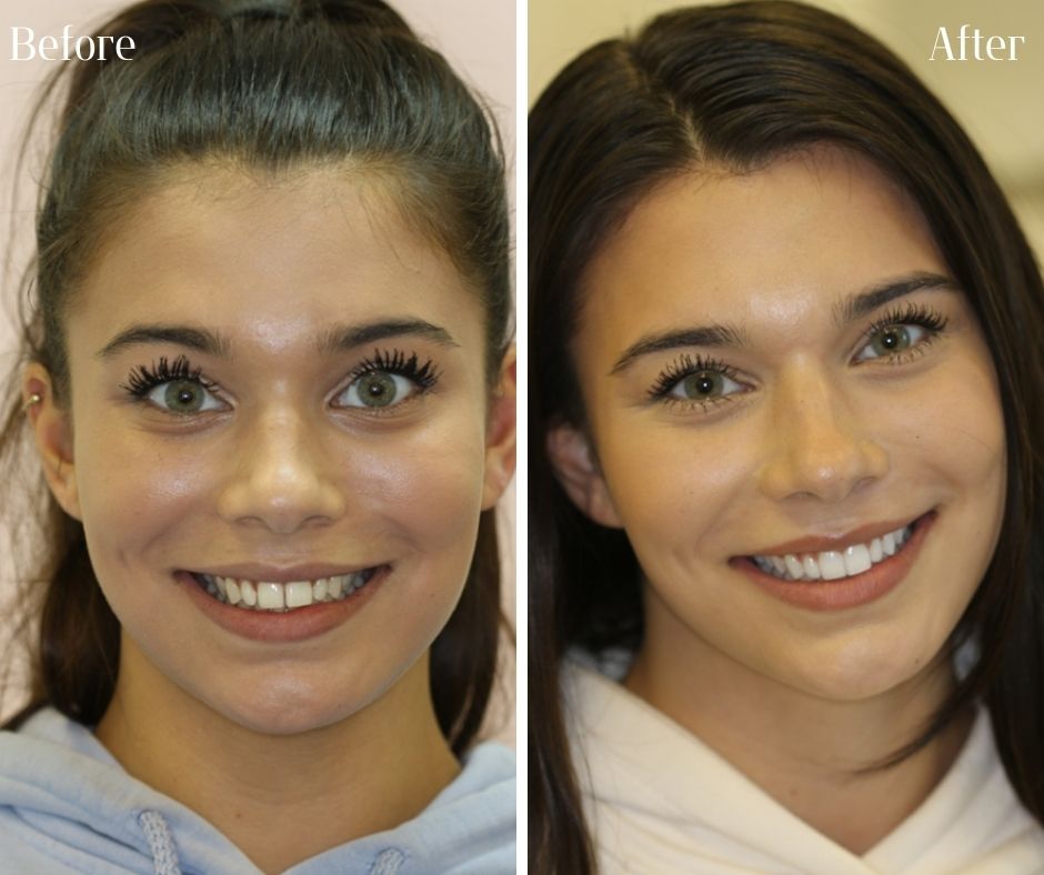 Composite Veneers - 740 Dental Smile Makeover Before and after