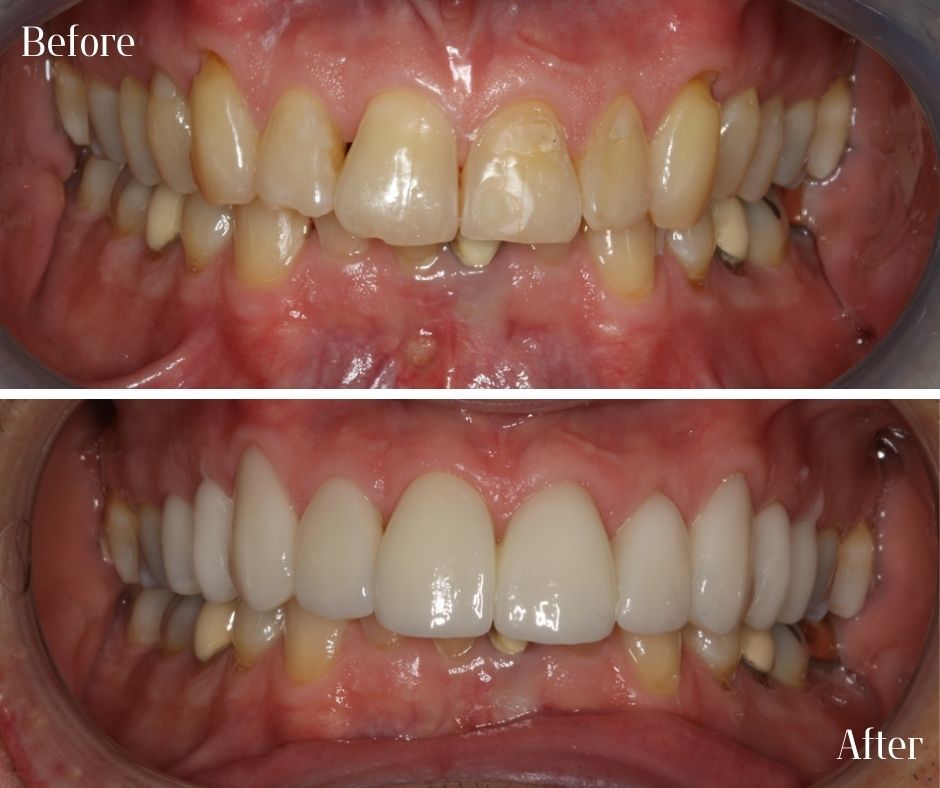 Composite Veneers - 740 Dental Composite Veneers - 740 Dental