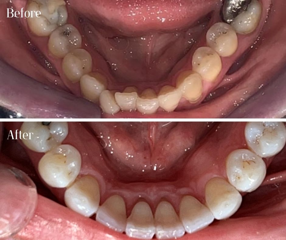 Straight Teeth Braces - 740 Dental Straight Teeth Braces - 740 Dental