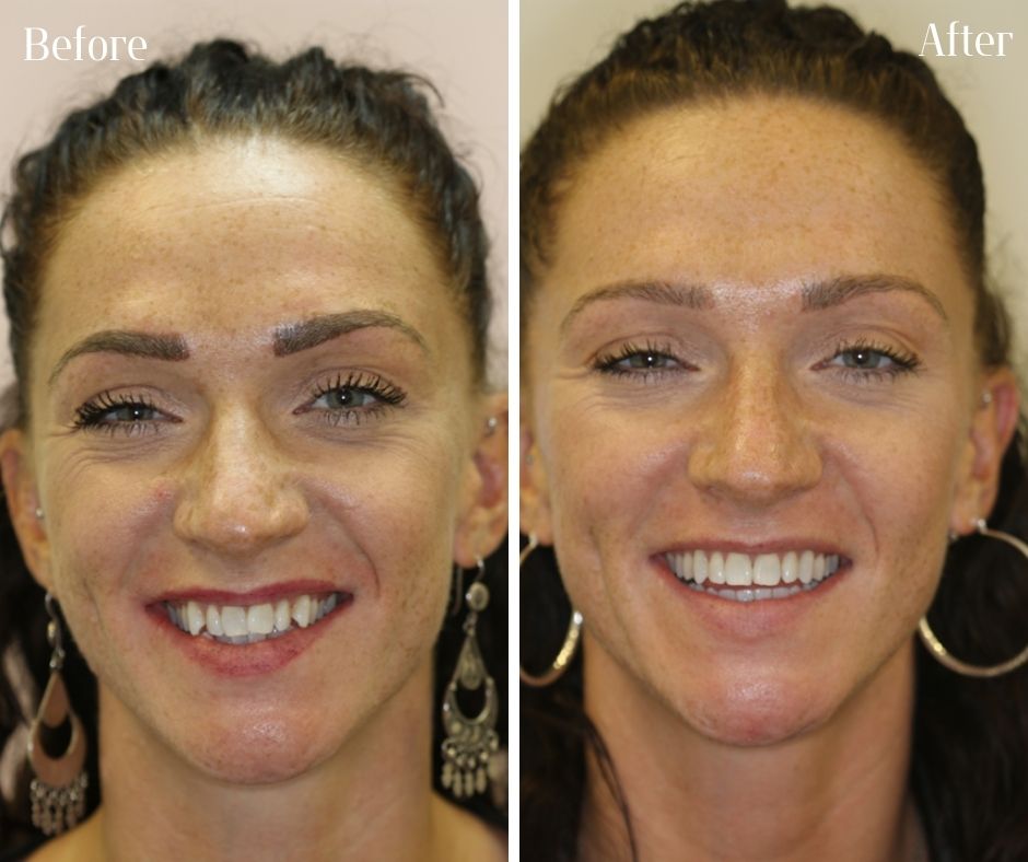 Straight Teeth Braces - 740 Dental Invisalign and braces treatment photos