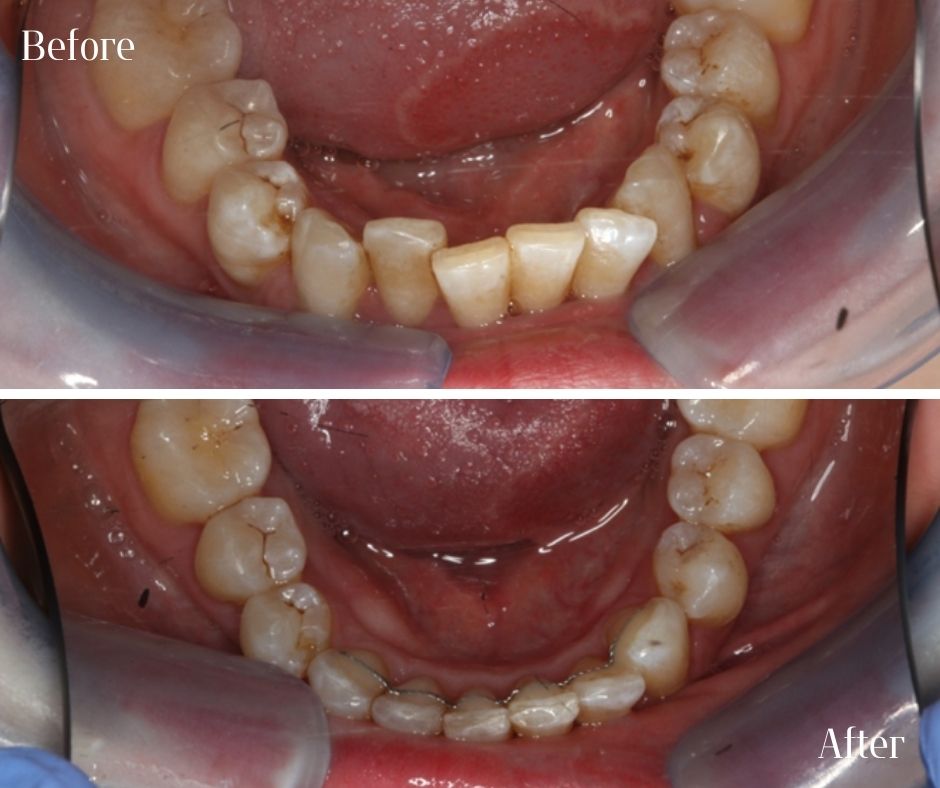 Straight Teeth Braces - 740 Dental Straight Teeth Braces - 740 Dental