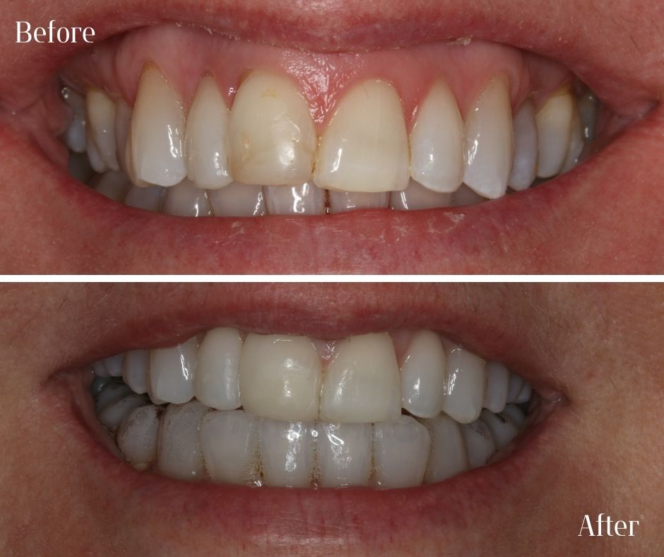 Composite Veneers - 740 Dental Composite Veneers - 740 Dental