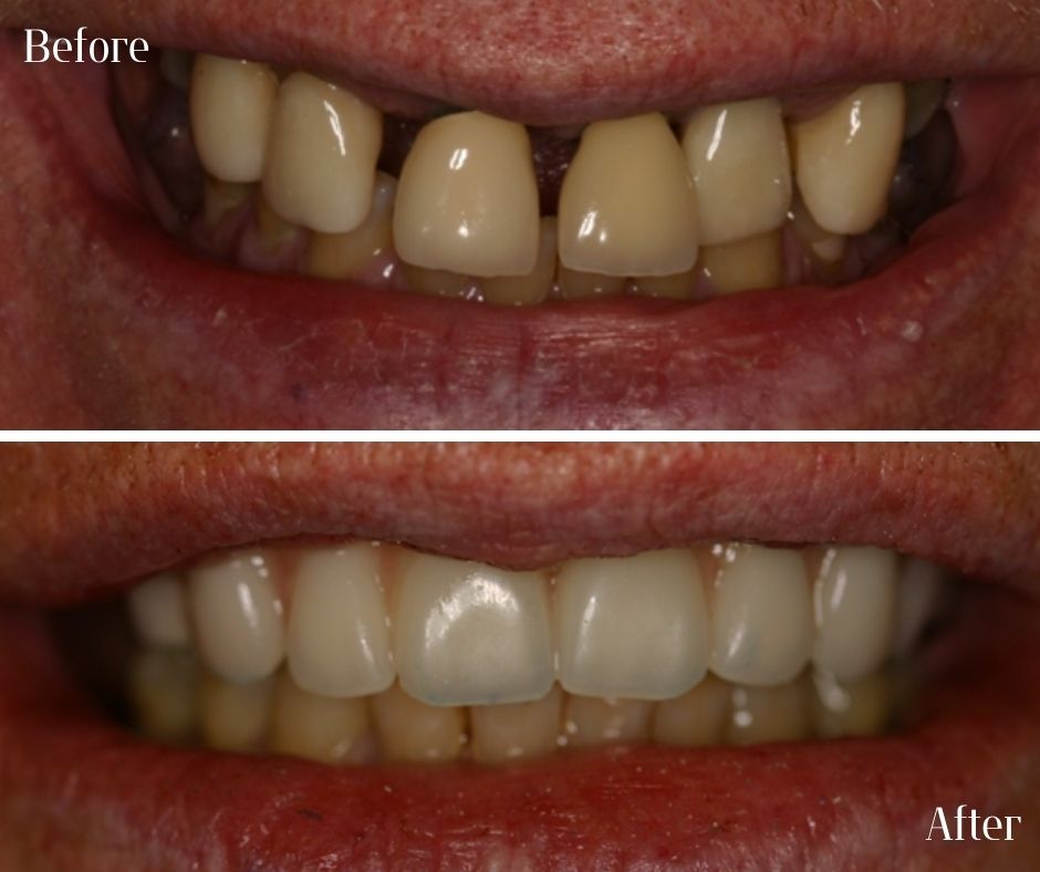 Dental Implants - 740 Dental Dental Implants treatment photos