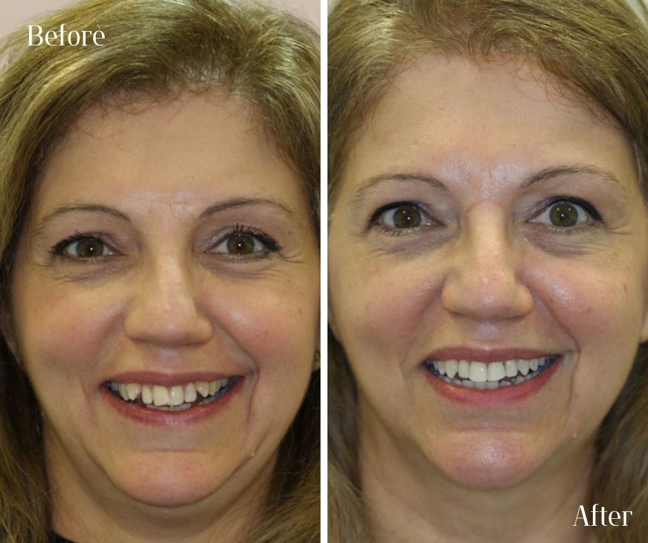 Composite Veneers - 740 Dental Smile Makeover Before and after