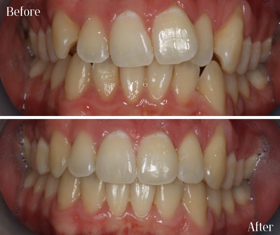 Straight Teeth Braces - 740 Dental Straight Teeth Braces - 740 Dental