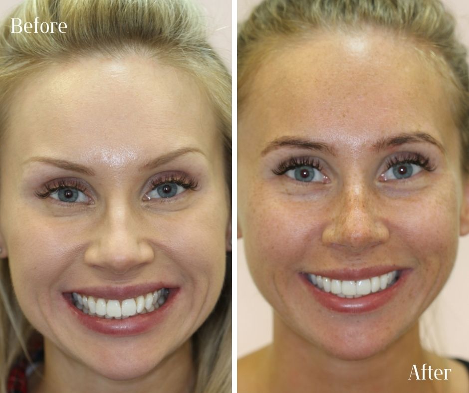 Composite Veneers - 740 Dental Smile Makeover Before and after