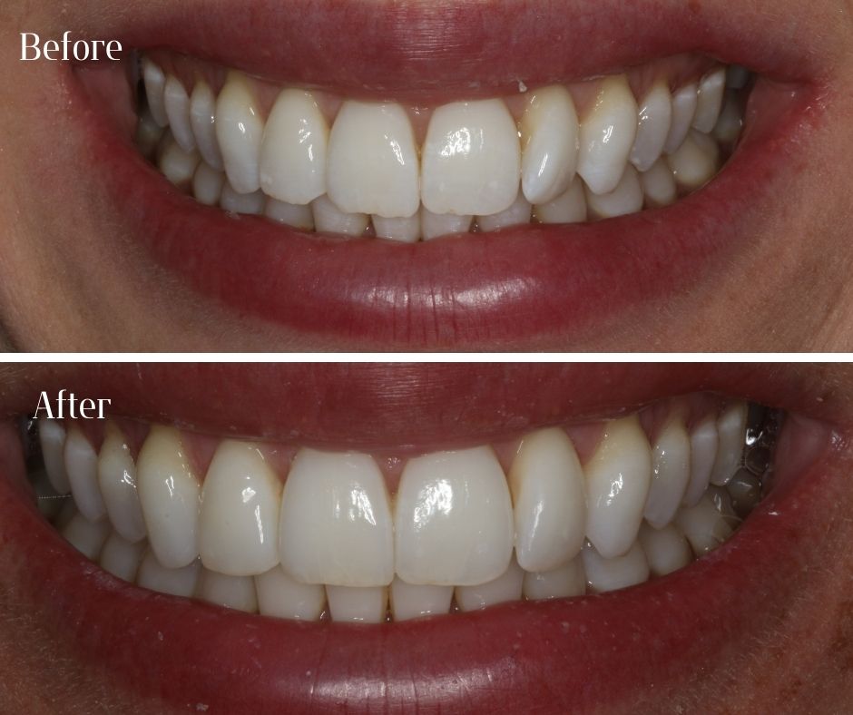 Composite Veneers - 740 Dental Composite Veneers - 740 Dental