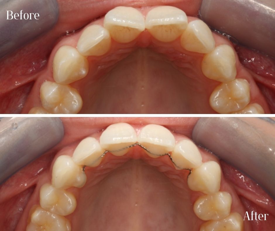 Straight Teeth Braces - 740 Dental Straight Teeth Braces - 740 Dental