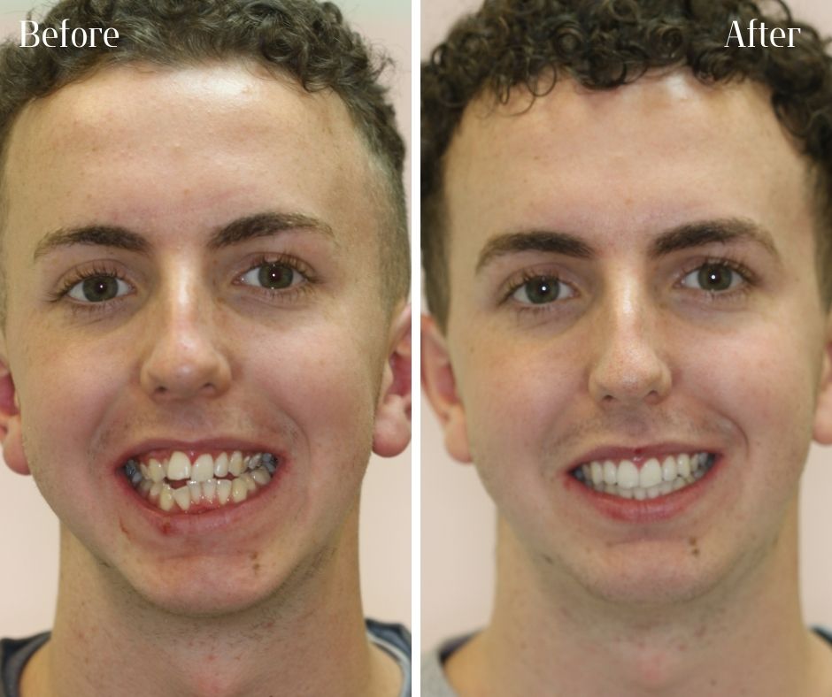 Straight Teeth Braces - 740 Dental Invisalign and braces treatment photos