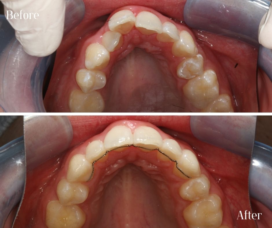 Straight Teeth Braces - 740 Dental Straight Teeth Braces - 740 Dental
