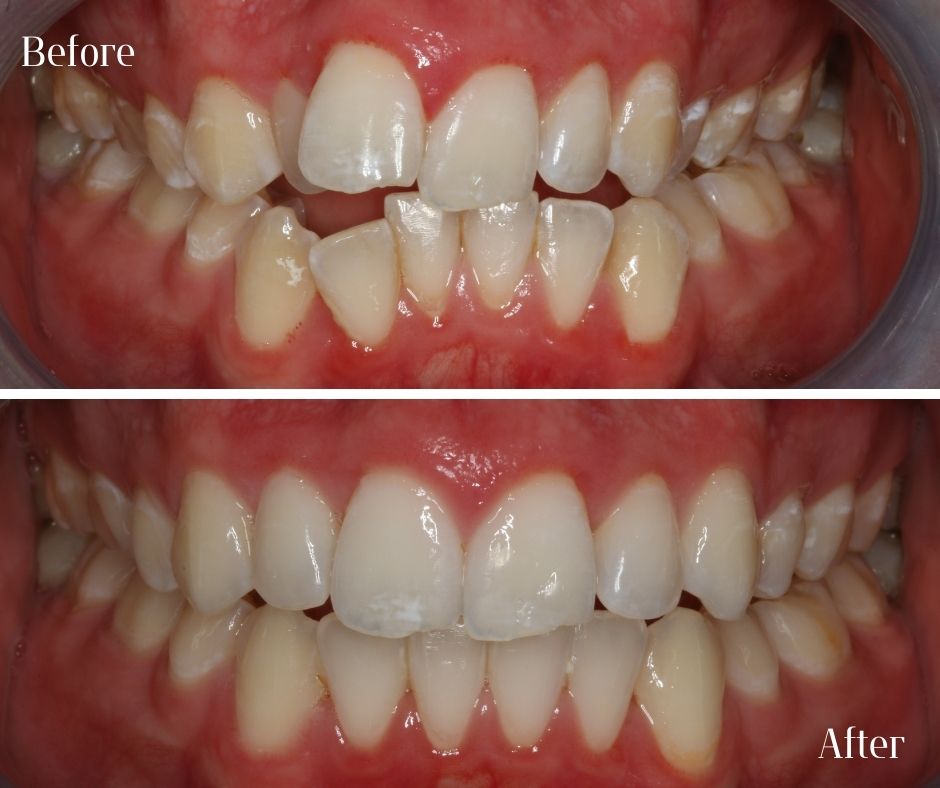 Straight Teeth Braces - 740 Dental Straight Teeth Braces - 740 Dental