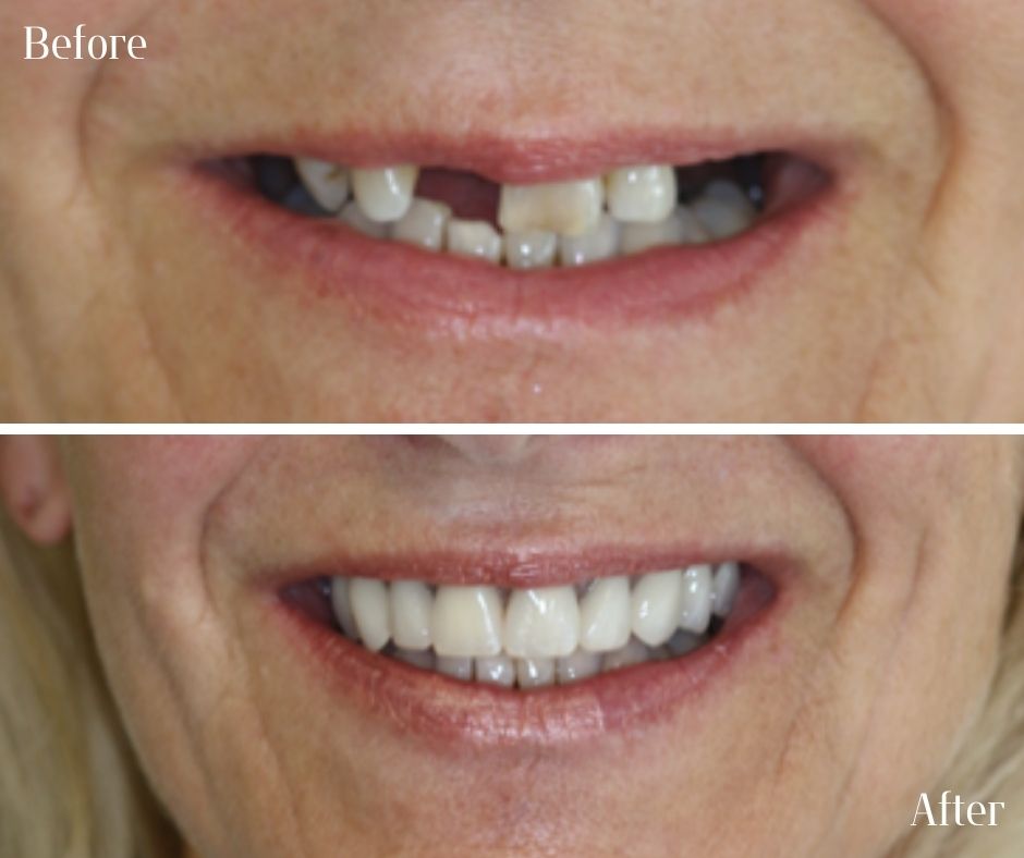 Dental Implants - 740 Dental Dental Implants treatment photos