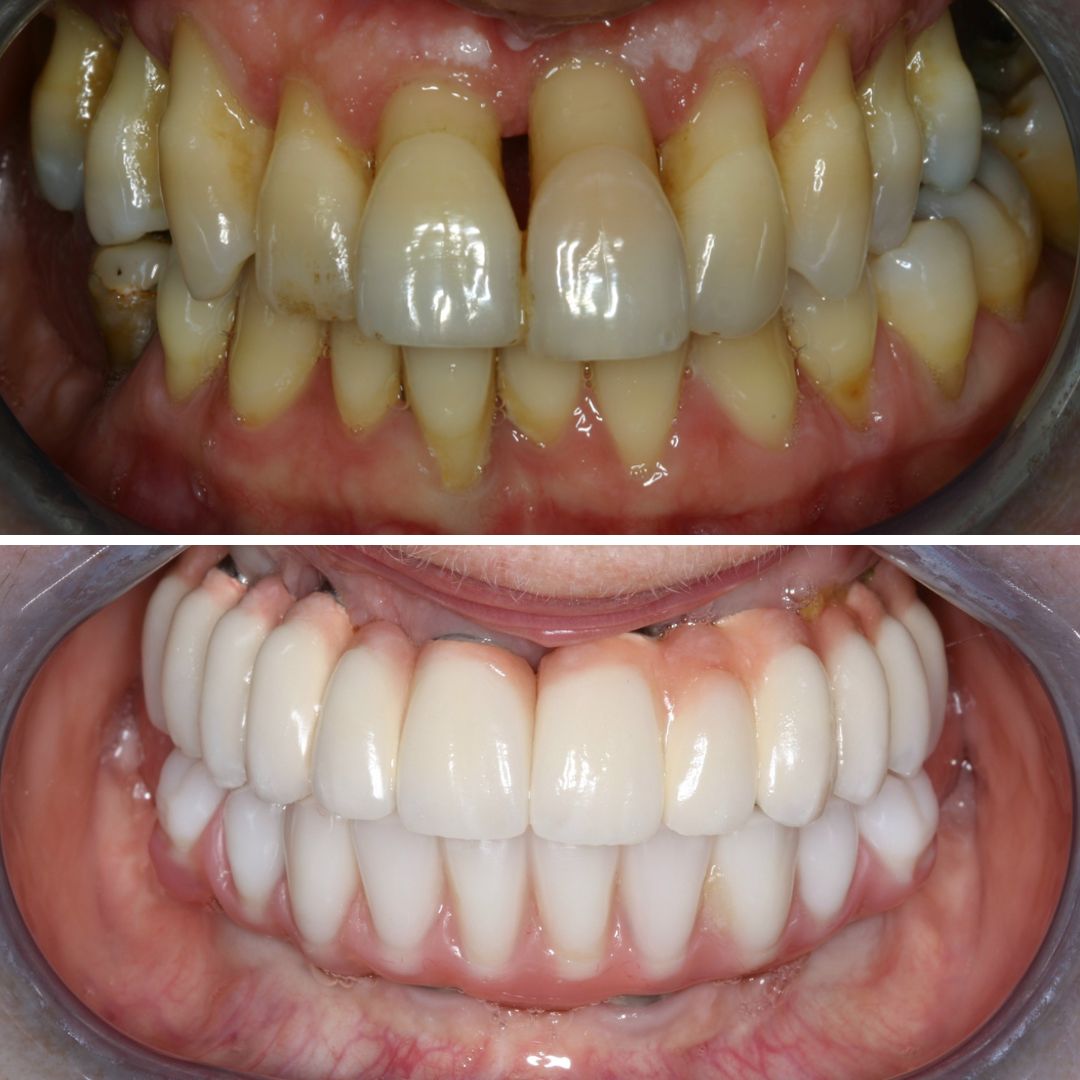 Dental Implants - 740 Dental Dental Implants treatment photos