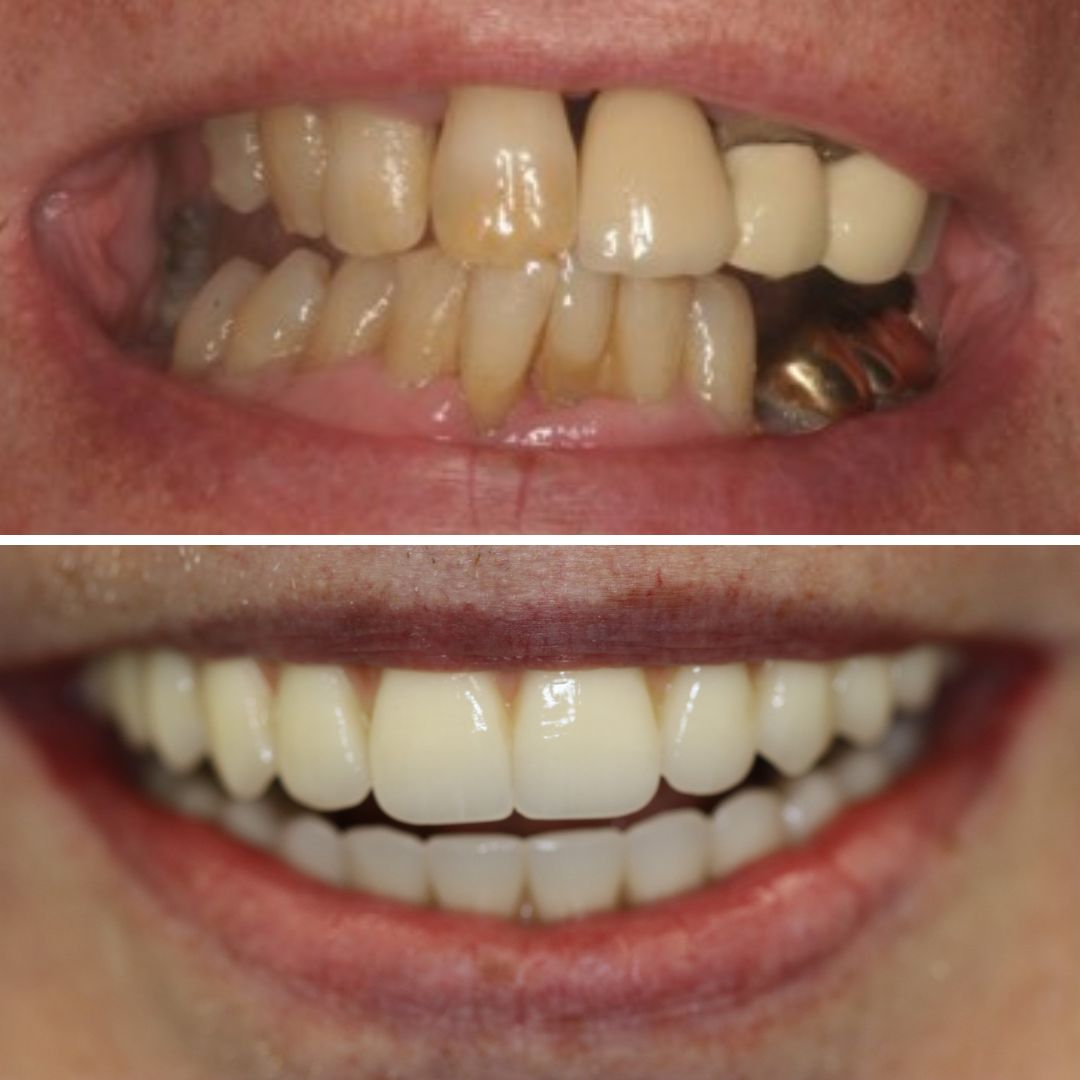 Dental Implants - 740 Dental Dental Implants treatment photos