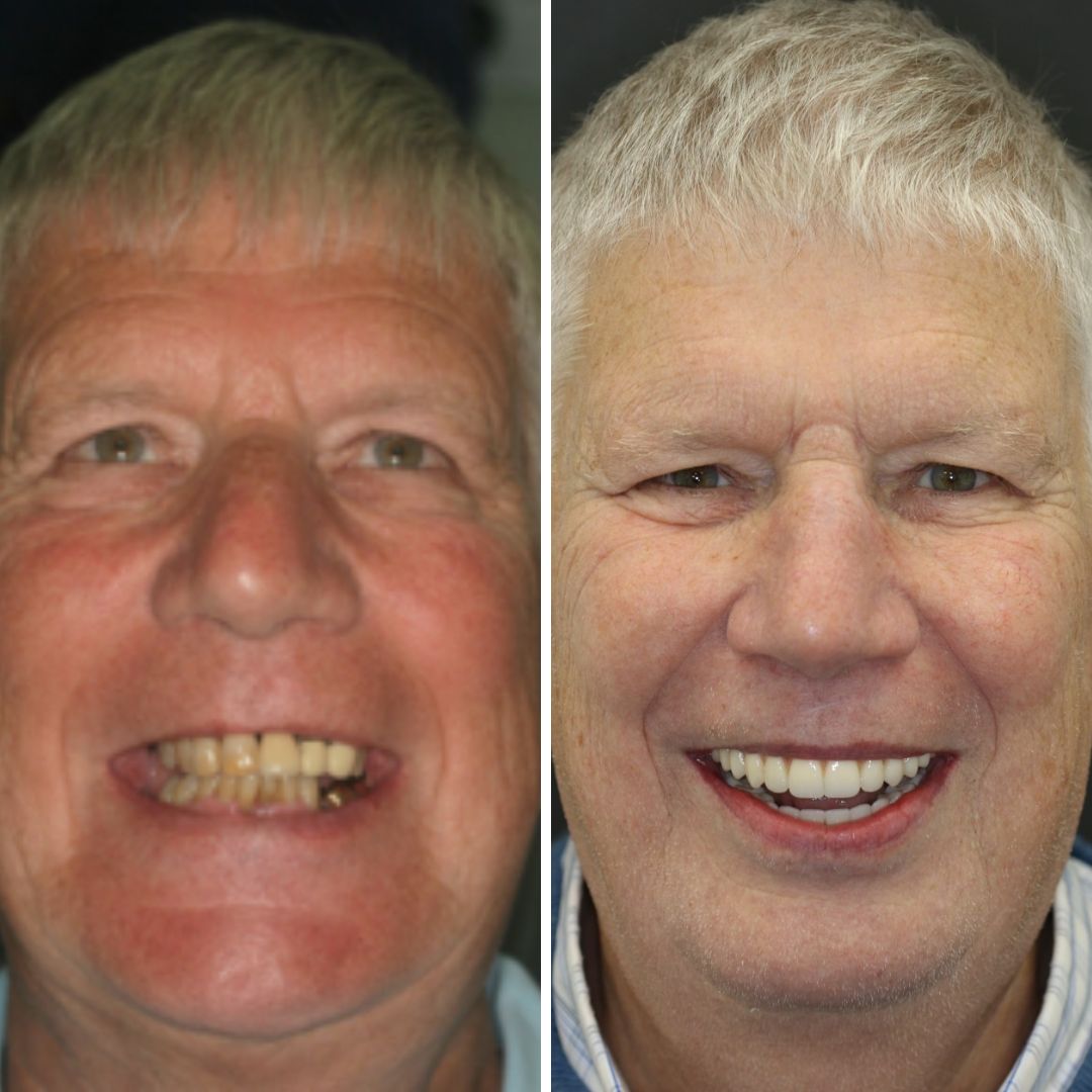 Dental Implants - 740 Dental 740 Dental – Your Destination For Dental Implants In Bournemouth
