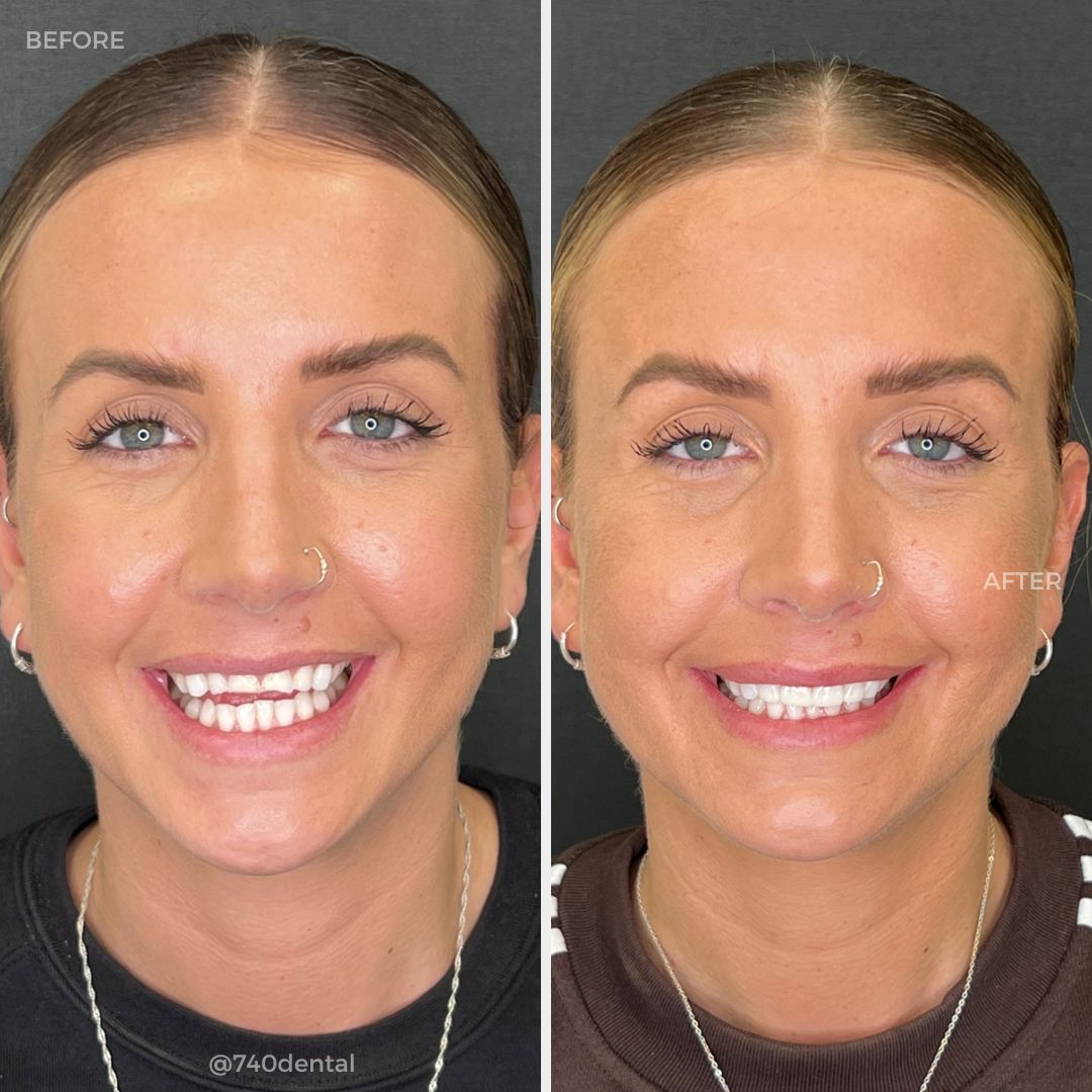 Teeth Whitening - 740 Dental Before and after teeth whitening