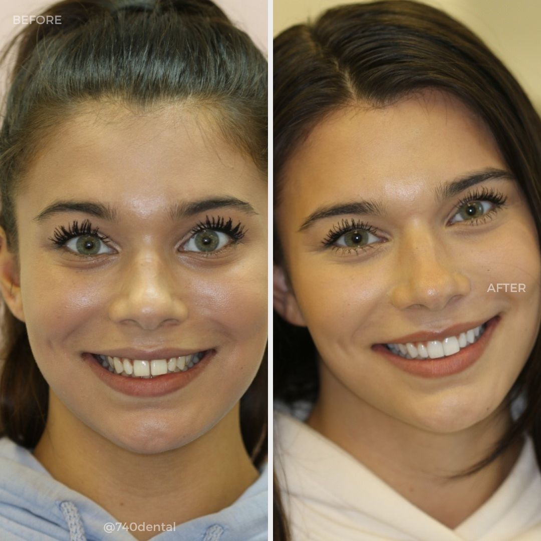 Teeth Whitening - 740 Dental Before and after teeth whitening