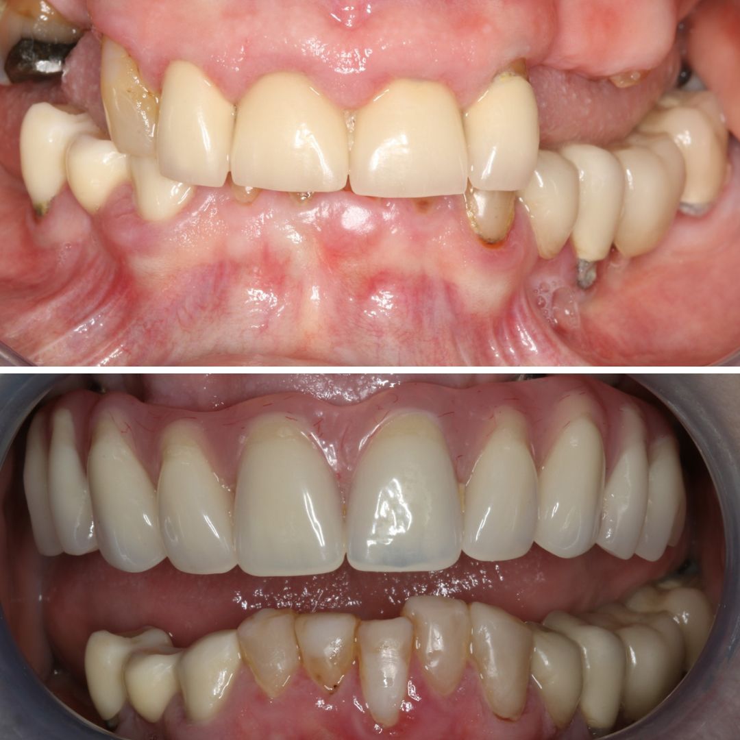 Dental Implants - 740 Dental Dental Implants treatment photos