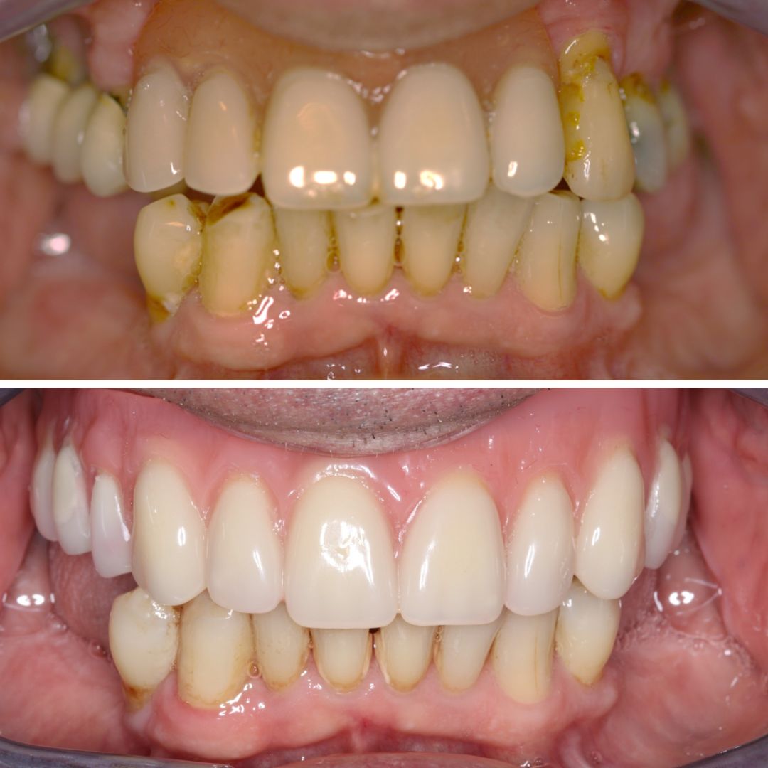 Dental Implants - 740 Dental Dental Implants treatment photos