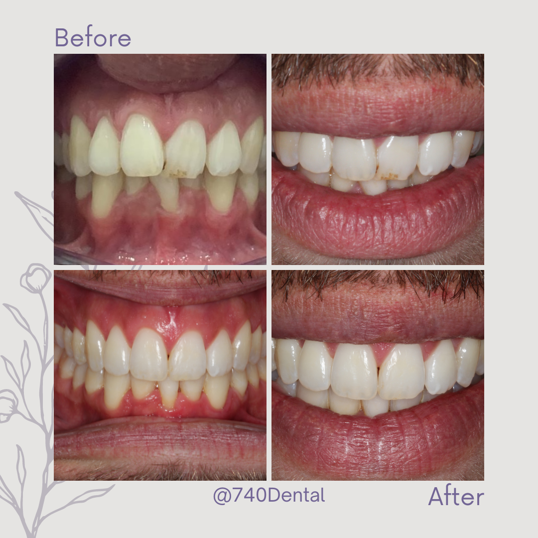 Straight Teeth Braces - 740 Dental Straight Teeth Braces - 740 Dental
