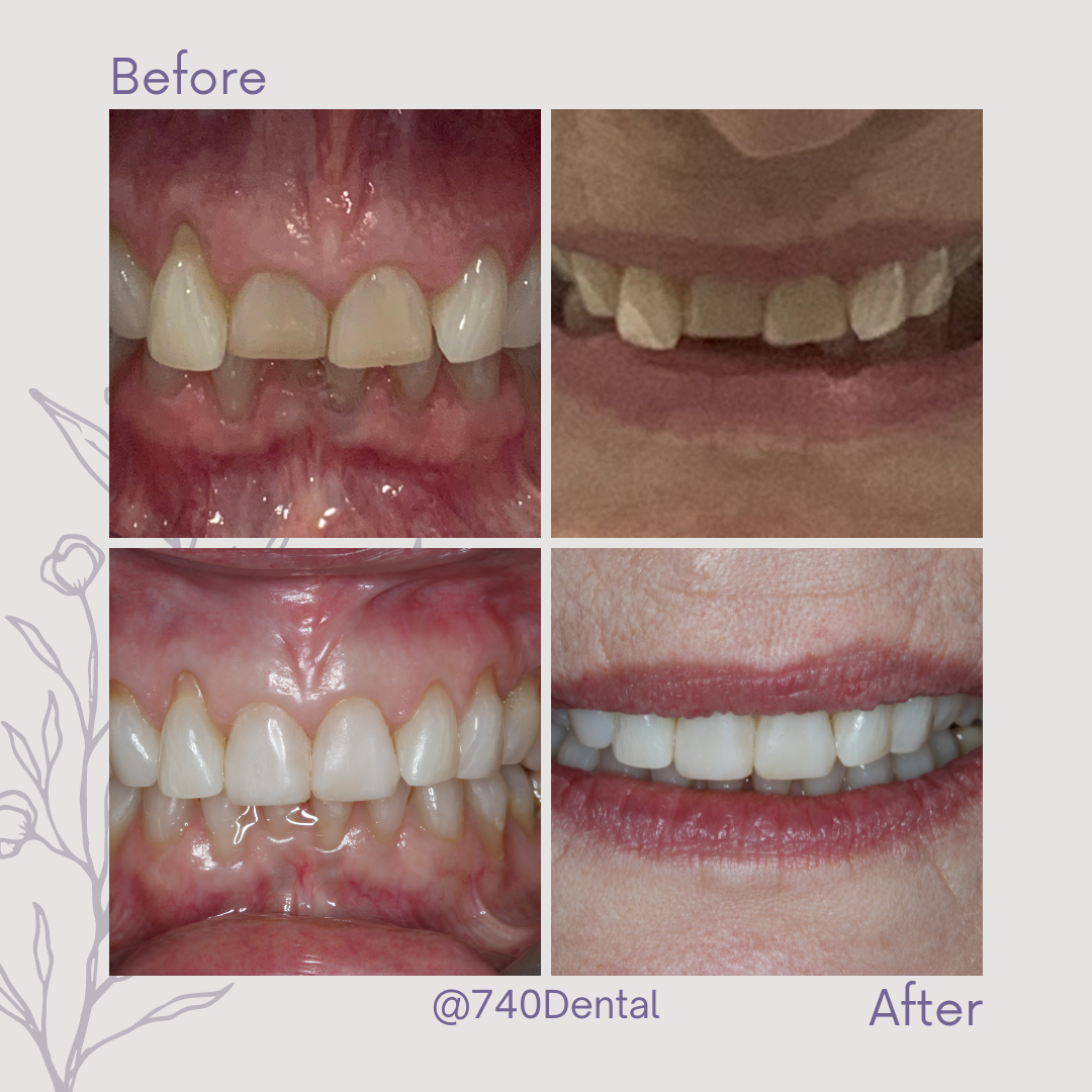Straight Teeth Braces - 740 Dental Straight Teeth Braces - 740 Dental