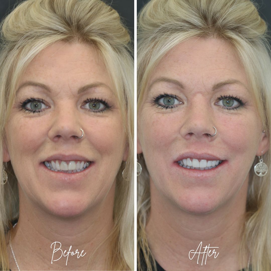 Composite Veneers - 740 Dental 740 treatment packages
